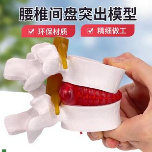 腰椎放大腰椎間盤受壓演示模型人體E脊柱脊椎骨病理椎間盤膨出模