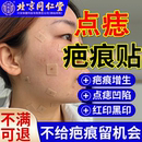 點痣去疤痕祛疤貼點斑專用祛痣后修去紅印消印復增生疤痕貼產品JW
